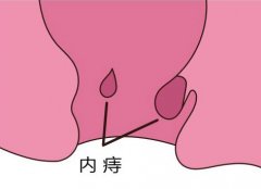 内痔就是火药桶？你知道为什么吗？