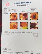 胃肠息肉病变之痛：一例早逝背后的警示